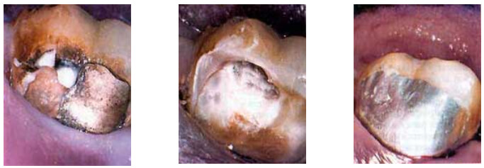 Figura 4. Imagen digital de restauración de molartomada con una cámara intraoral