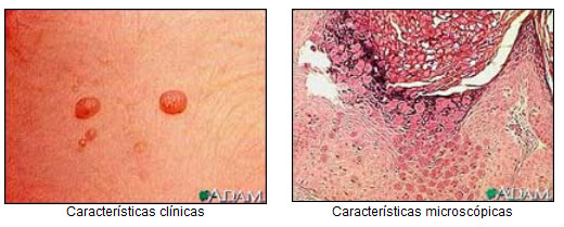 Características clínicas / Características microscópicas