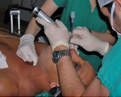 Figura 2 B: Técnica de intubación orotraqueal