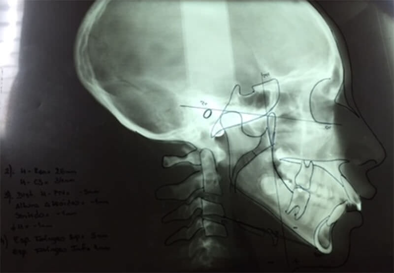 Figura 7: Telerradiografía de perfil con Trazado cefalométrico sobre negatoscopio