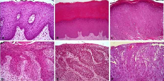 Figura 1. Cambios histológicos en la mucosa oral observados en las diferentes etapas de la transformación maligna. A. Mucosa de aspecto normal que presenta acantosis sin atipia; B. Mucosa hiperqueratinizada con acantosis e hipergranulosis; C. Mucosa queratinizada que presenta displasia epitelial de bajo grado; D. Mucosa que presenta displasia de alto grado; E. Carcinoma de células escamosas microinvasor; F. Carcinoma de células escamosas bien diferenciado que invade la lámina propia.