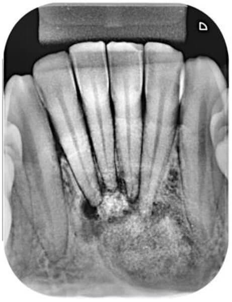 Figura 5: Control radiográfico del 4to año. Displasia cemento-ósea en etapa avanzada de la fase cementoblástica. Radiográficamente existe fusión de las radiopacidades con un halo fino radiolúcido en su alrededor. Puede ser observado que el ligamento periodontal todavía se mantiene integro en los dientes adyacentes a la lesión