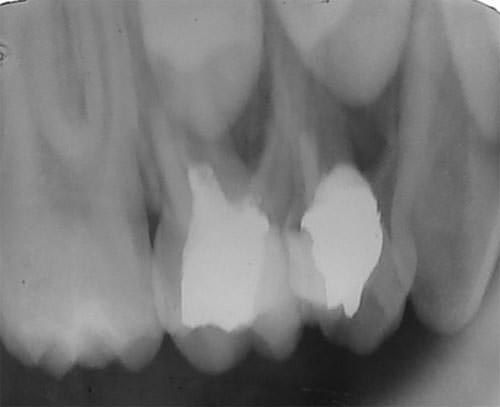 Figura 1 Imagen radiolúcida de bordes poco definidos, compatible con un absceso crónico en la zona cercana a la furca del primer molar primario superior observada al 3er mes de realizada la pulpotomía con formocresol.