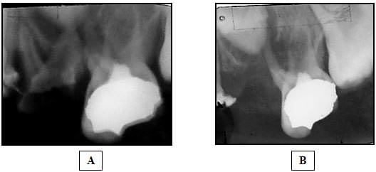Figura 2 Amplitud localizada en el trayecto del conducto de la raíz palatina del segundo molar primario superior compatible con un proceso de reabsorción radicular interna (A) al 2do mes y (B) al 3er mes de realizada la pulpotomía con formocresol. Adelgazamiento en la raíz mesial del segundo molar primario superior compatible con un proceso de reabsorción radicular patológica externa atípica y asimétrica observada al 3er mes de realizada la pulpotomía con formocresol.
