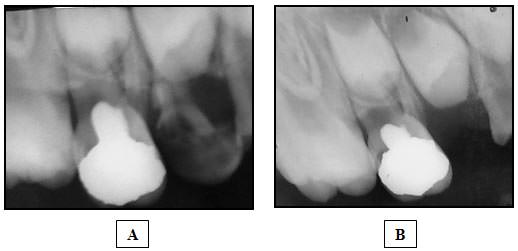 Figura 3 Amplitud localizada en el trayecto del conducto de la raíz palatina del segundo molar primario superior compatible con un proceso de reabsorción radicular interna (A) al 2do mes y (B) al 3er mes de realizada la pulpotomía con formocresol.