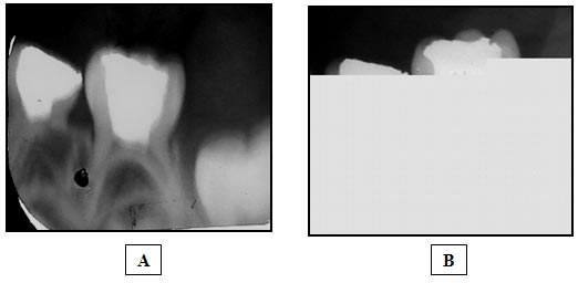 Figura 4 Amplitud localizada en el trayecto del conducto de la raíz distal del primer molar primario inferior compatible con un proceso de reabsorción radicular interna (A) al 2do mes y (B) al 3er mes de realizada la pulpotomía con pasta iodoformada.