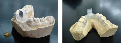 Figura Nº 2 Colocación de la férula en la impresión de arcada del modelo de yeso piedra.