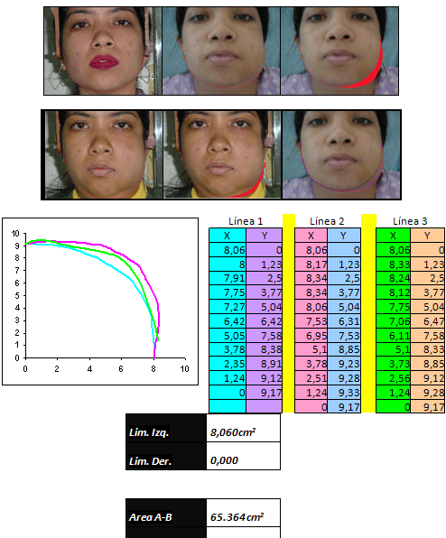 Gráfico 3 Cuantificación del edema extra-oral de la primera paciente infectada, 3er día posterior a la intervención quirúrgica. Cálculo del Area del Edema Izquierdo "Modelo Facultad Odontología U.C.V"