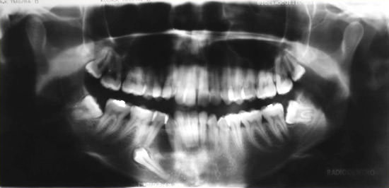 Figura 1 Ortopantomografía mostrando lesión en cuerpo mandibular del lado izquierdo.