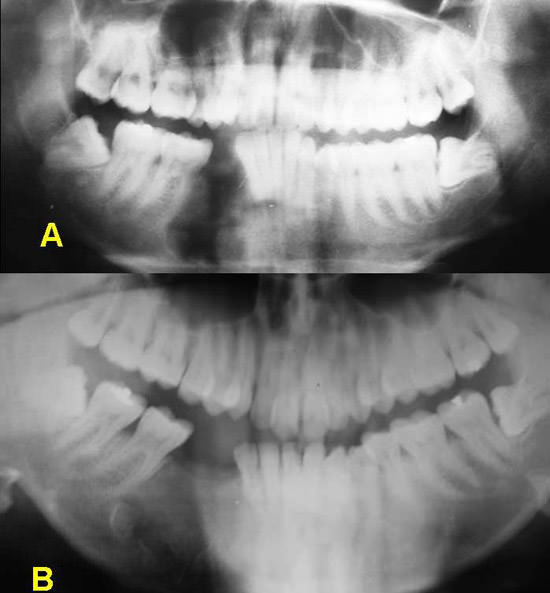 Figura 4 A - Post-operatório imediato; Fig 04. B - Después de 02 años de seguimiento, se observa neoformación ósea.