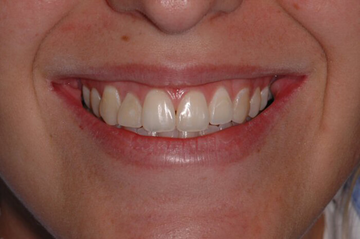 Figura 1 Aspecto de la sonrisa inicial del paciente, presentando desarmonía en la composición dentaria.