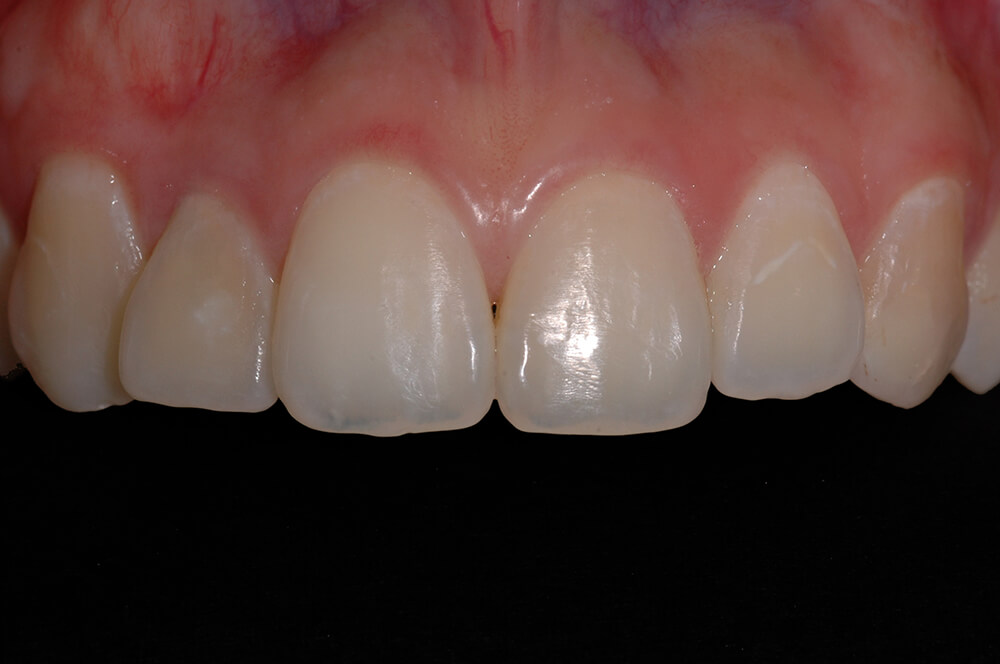 Figura 2 Detalle de los dientes anterosuperiores con ligero desalineamiento dentario