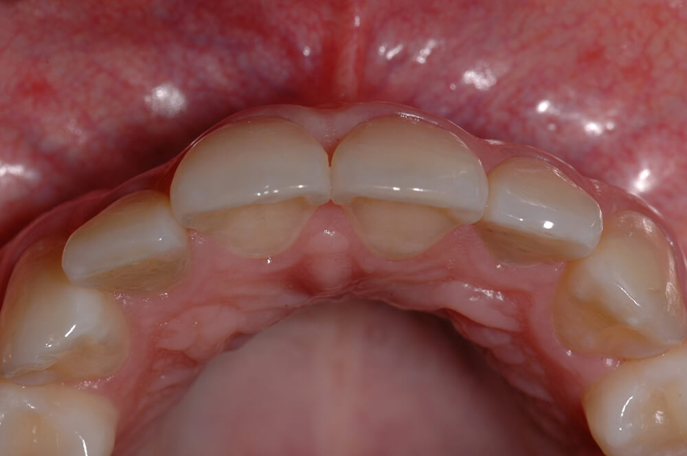 Figura 3 Vista incisal de los dientes anterosuperiores presentando desalineamiento y desarmonía en el arco dentario.