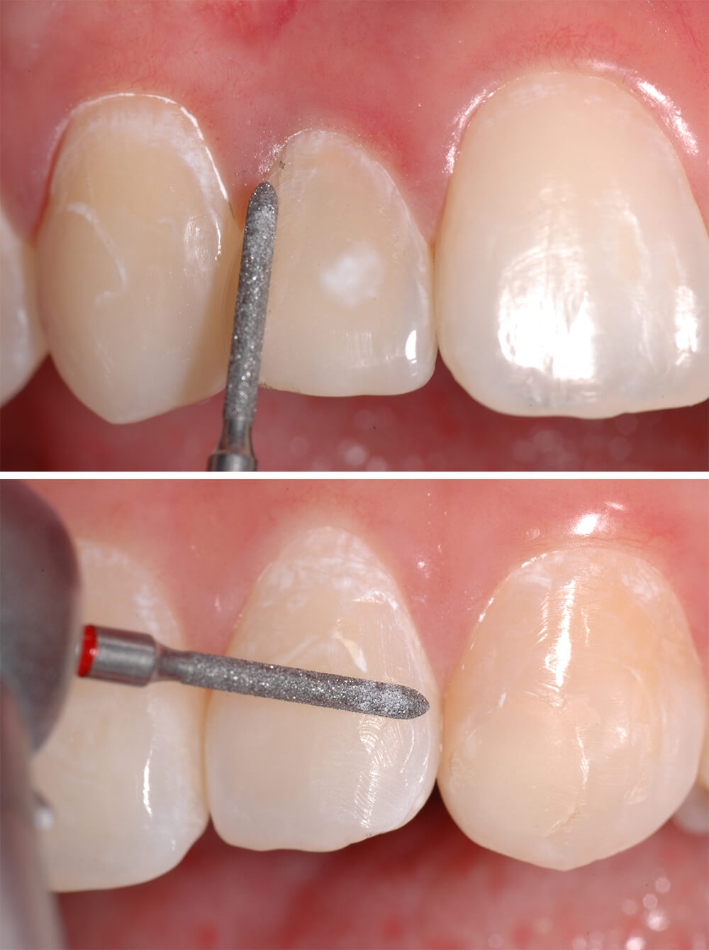 Figura 5 Fresa diamantada remodelando por desgaste la cresta próximo distal prominente de la superficie vestibular de los incisivos laterales superiores derecho (A) e izquierdo (B).
