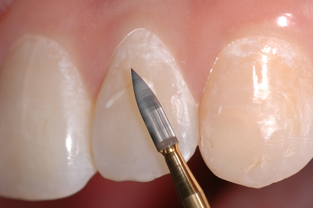 Figura 6 Fresa multilaminada rotando en alta velocidad para la remoción de las rugosidades dejadas por las fresas diamantadas, en los dientes remodelados..