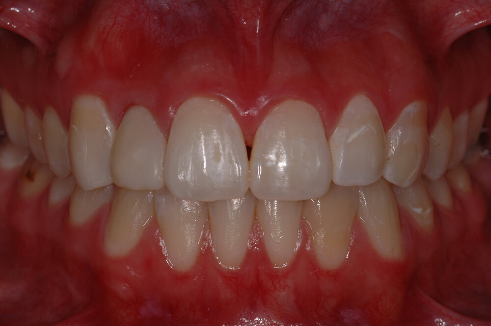 Figura 11 Post operatorio que nos muestra la nueva composición dentaria.