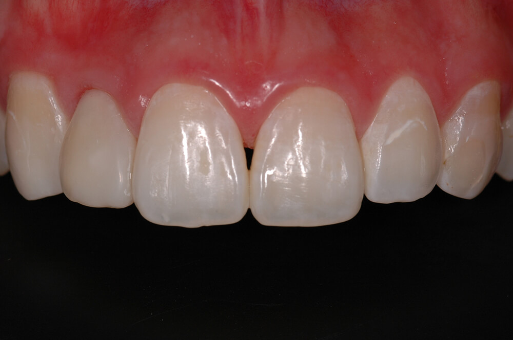Figura 12 Pormenor de los dientes anterosuperiores que nos muestra los resultados estéticos alcanzados luego de la remodelación cosmética.