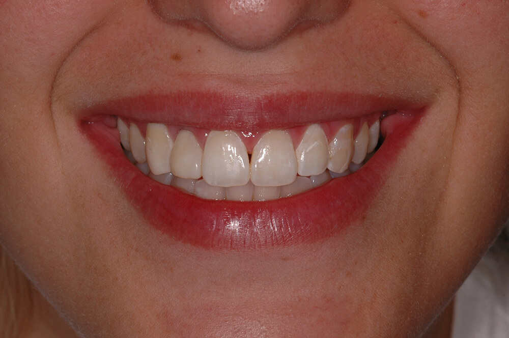 Figura 13 Aspecto final de la sonrisa.