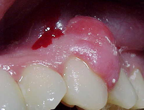 Fig 1 Características clínicas: masa voluminosa localizada entre 23 y 24, de superficie lisa, con cambios de coloración hacia apical de la lesión; consistencia firme y base sésil. De 10mm en sentido apico-incisal y de 6mm en sentido mesio-distal, indolora