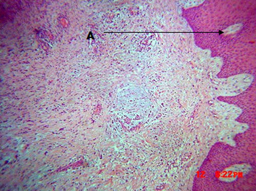 Fig 2 Microfotografía (HE) donde se identifica tejido tapizado por un epitelio plano estratificado con cambios de acantosis (A), en el corion se identifica a bajo aumento, (Lupa), una respuesta inflamatoria crónica (tejido de granulación) el cual se dispone a la periferia de una de una sustancia de aspecto mucinoso la cual se observa de un color basófilo.