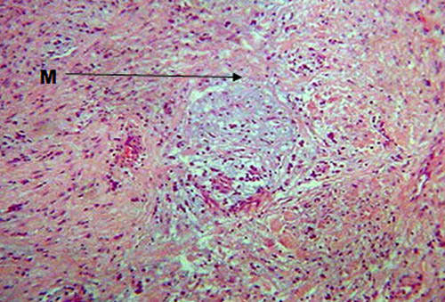 Fig 3 A mayor aumento (10X) se identifica el área central de aspecto mucinoso (M).