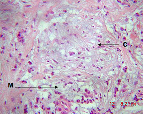 Fig 4 La Lesión observada a 40X donde identificamos una matriz mucinosa (M) en cuyo seno se identifica células estrelladas y otras alargadas, con pequeñas prolongaciones que se emiten a la periferia (C).