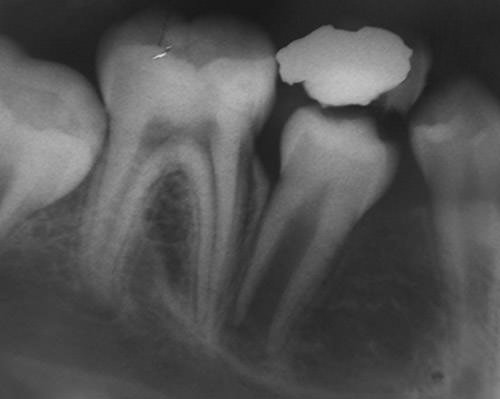 Figura 1 Radiografía retroalveolar diente 8.5 con obturación extensa y reabsorción radicular avanzada. Se aprecia lesión radiolúcida delimitada asociada a diente 4.5 incluida.