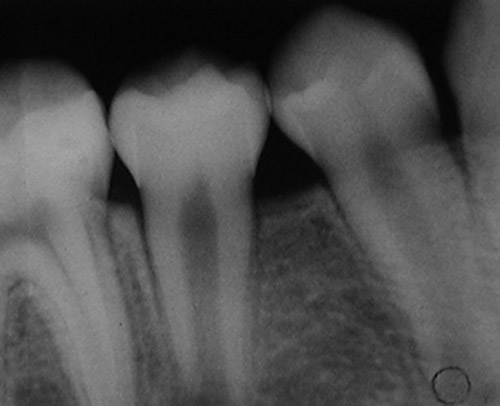 Figura 3 Radiografía retroalveolar diente 4.5. Control radiográfico 4 meses posterior a la exodoncia del diente 8.5. Se aprecia formación ósea y erupción del premolar.