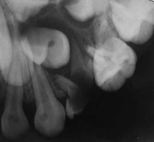 Figura 4 Radiografía retroalveolar resto radicular diente 6.4 asociado a lesión radiolúcida de límites netos que desplaza gérmenes dentarios.