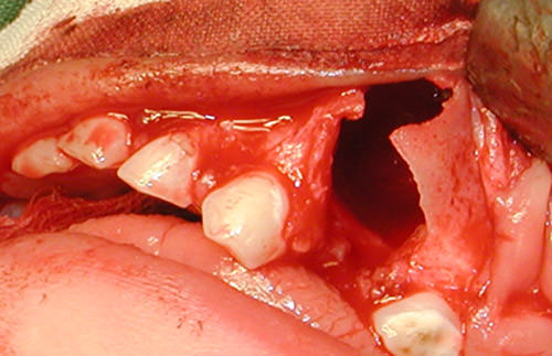 Figura 5 Exodoncia resto radicular 6.4, enucleación de la lesión y exodoncia de premolar incluido.