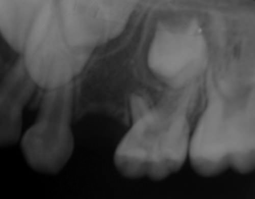 Figura 6 Radiografía retroalveolar diente 6.4. Control radiográfico 10 meses postquirúrgico. Se aprecia formación ósea de la zona.