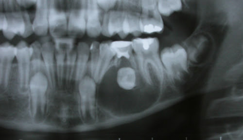 Figura 8 Radiografía panorámica. Se aprecia diente 3.5 incluido en posición ortográfica asociada a lesión radiolúcida de límites netos entre dientes 3.4 y 3.6 que se extiende hasta el borde basilar.