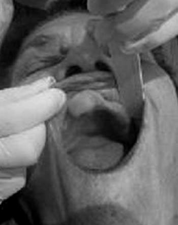 Fig. 1 Nódulo de base sésil, color de la mucosa normal, en reborde alveolar