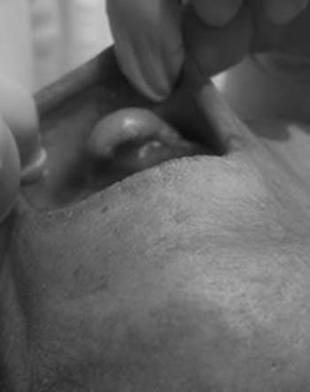 Fig. 2 La lesión abarca el área incisiva, pasando la línea media. Maxilar.