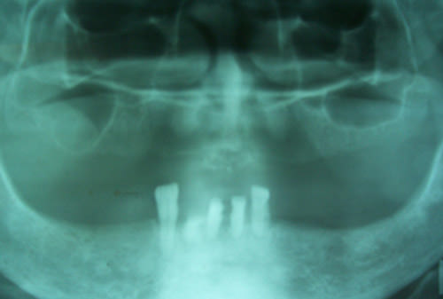 Fig.3 Rx panorámica. Nótese radiopacidades en el área de la tumoración. El hueso está intacto.
