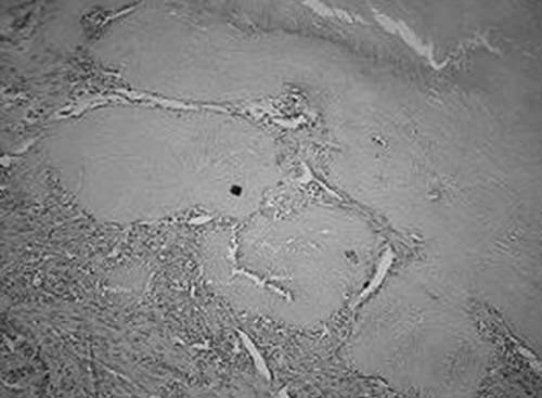 Fig. 4 Microfotografía (10 X) observa material, calcificado cementoide.