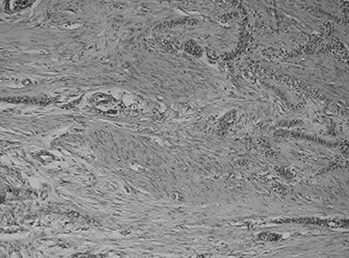 Fig. 4 Microfotografía (10 X) observa material, calcificado cementoide.