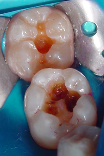 Figura 2 Retiro de la amalgama y diseño cavitario de 46 y 47, empleando sustancias reveladoras de caries, logrando pisos cavitarios con zonas de dentina sana, afectada y esclerótica.