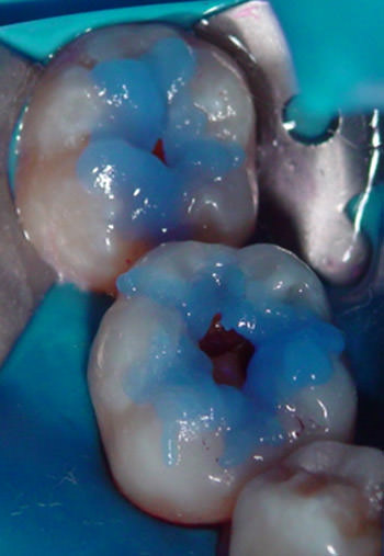 Figura 3 Acondicionamiento ácido selectivo y simultáneo, con ácido poliacrílico en dentina y ácido fosfórico en esmalte por 15 - 20 segundos.
