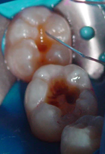 Figura 4 Lavados los ácidos acondicionadores se aplica Clorhexidina al 2% por 30 segundos en dentina, para lavar nuevamente las cavidades.