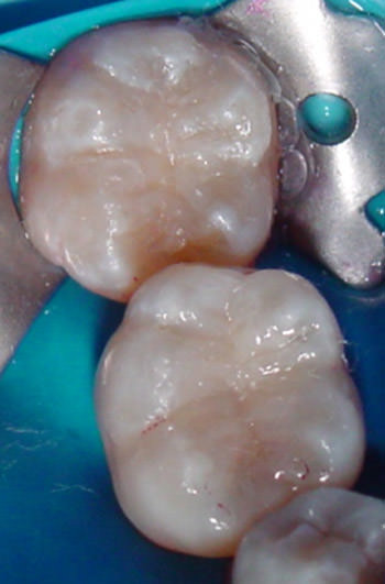 Figura 9 Restaurados los dientes con resina compuesta en técnica incremental oblicua para minimizar los efectos de la contracción de polimerización del material.