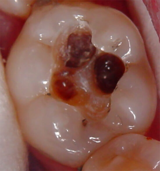 Figura 10 Condición inicial del diente 46, al retirar la amalgama y la base hidrosoluble que poseía. La lesión cariosa activa en dentina es notoria en la zona distal del piso cavitario.