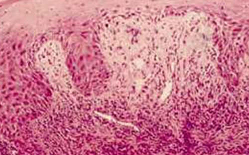 Figura 1 Eritema multiforme con edema, inflamación, y proliferación vascular en tejido conectivo y algún edema inter e intracelular en el área basal del epitelio. (5)