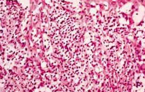 Figura 2 Formación vesicular, observada en la membrane basal, zona acompañada por una respuesta inflamatoria marcada en un caso de eritema multiforme. (5)