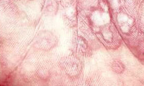 Figura 4 Eritema multiforme clásico lesiones de piel que puede, aparecer similar a un objetivo y se observan mayormente en palmas de las manos. (5)