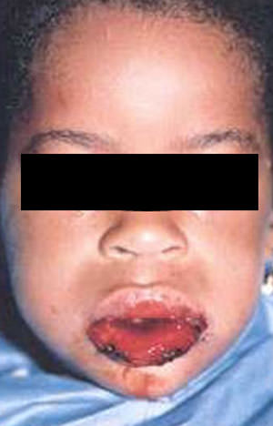 Figura 5 Eritema multiforme menor produce un severo dolor de rápido inicio precoz: niña de 5 años de edad con un desarrollo de 3 lesiones de piel similar a y un dolor moderado en los labios en menos de 18 horas después de aplicarse antibiótico cefaclor. (5)