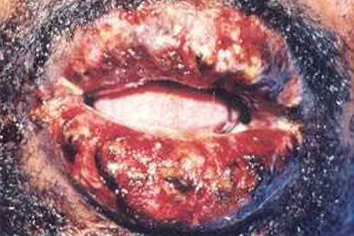 Figura 8 En menos de 24 horas, el comienzo de las erosiones se han necrosado completamente la superficie del Bermellón para crear un labio doloroso y hemorrágico. (5)