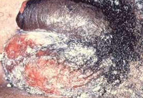 Figura 9 Las lesiones genitales del eritema multiforme mayor son necrosis en piel del escroto y pene. Un porcentaje de sulfadiazina de plata es utilizado como crema antimicrobiana similar en el manejo de quemaduras. (5)