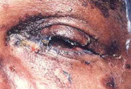 Figura 10 Las lesiones oculares del eritema multiforme mayor son en cornea y necrosis a lo largo de la conjuntiva con necrosis en algunas zonas de piel. La perdida de la visión en menos de 36 horas es debido a la perdida de la cornea. (5)
