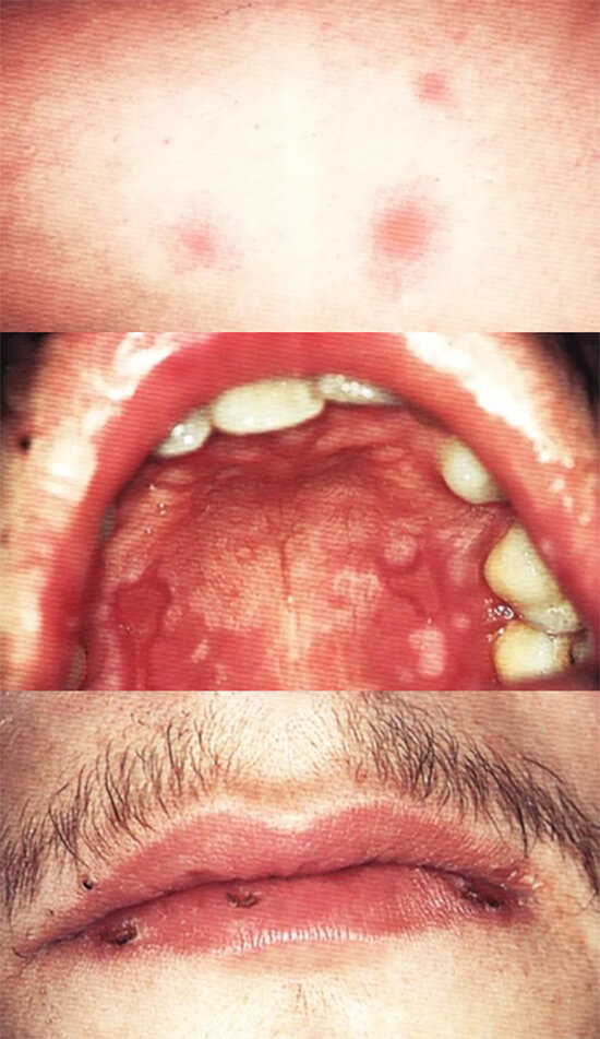 Figura 11 El eritema multiforme se caracteriza por lesiones cutáneas concéntricas y a veces por ulceraciones gingivales. Ayudan al diagnóstico la ulceración y las costras en el borde bermellón del labio. (63)
